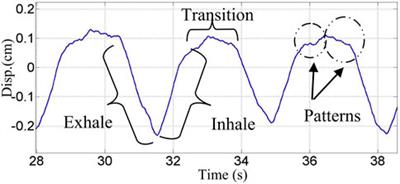 Doppler radar remote sensing of respiratory function